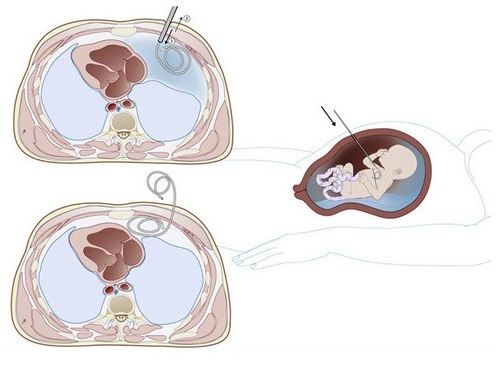 Shunt Insertion (Bladder and Thorax)